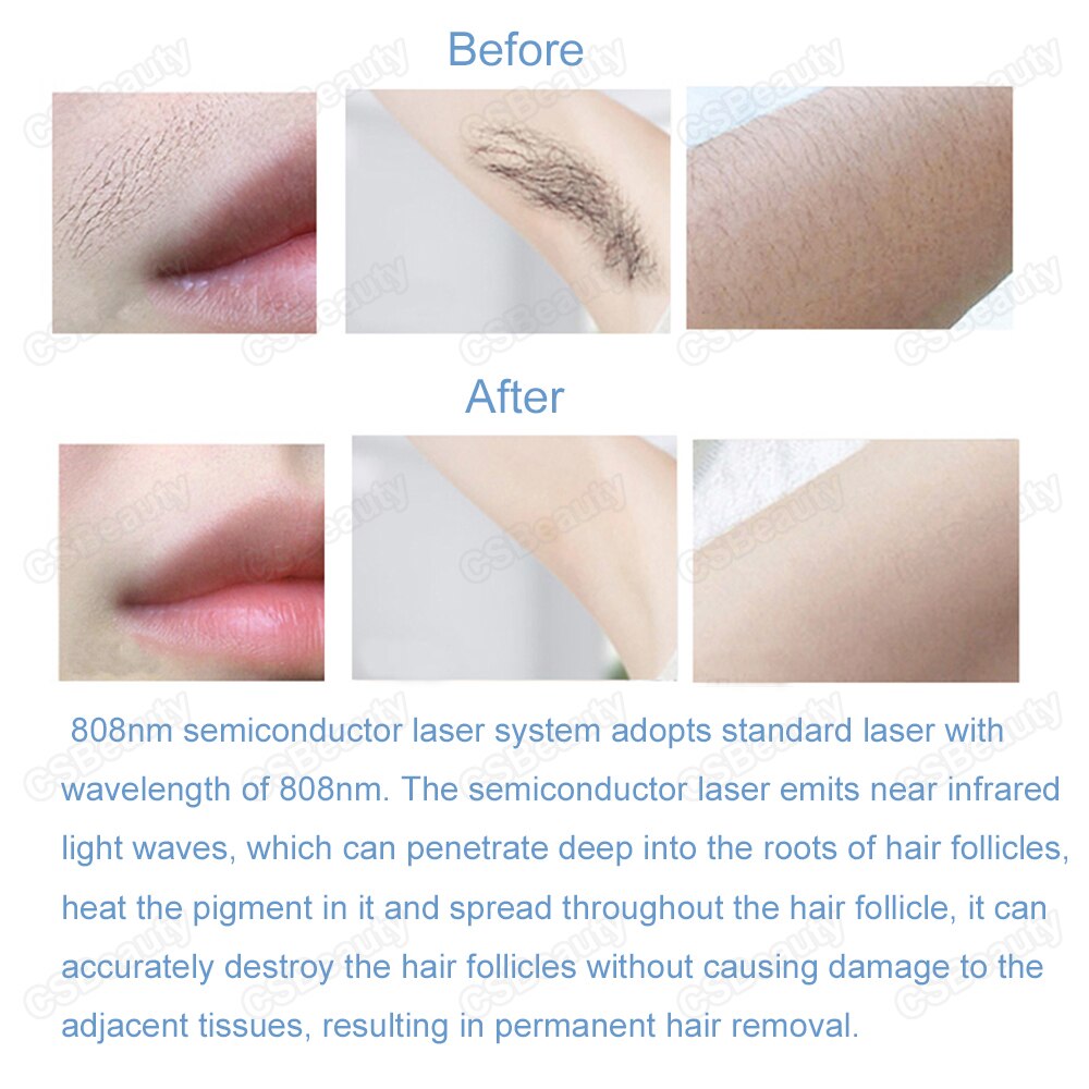 2021 New Portable 808nm Diode Laser Ice Hammer 2 in 1 Removal Machine Hair Remover Homeuse Spa Salon Skin Care Beauty Device - Image 4