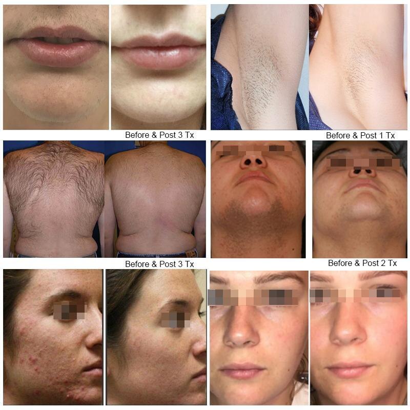 CE 30 Million Shots Diode Lazer 808 Diode Laser Hair Removal Machine for Hair Removal Skin Tightening Rejuvenation Equipment - Image 5