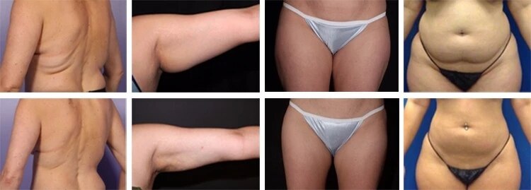 Home use mini lipo laser dual wavelength 650nm lipo laser lipo slimming/weight loss diode lipo laser - Image 5