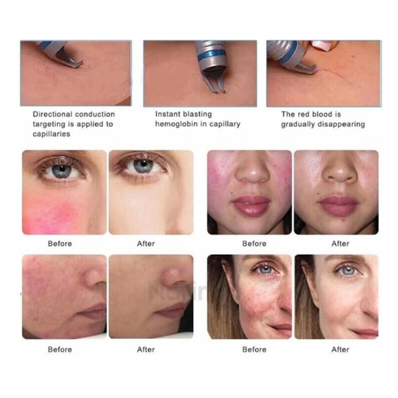 New Professional 30w 980nm Diode Laser for Facial Spider Vein Removal Machine Skin Rejuvenation Beauty Salon SkinCare - Image 5