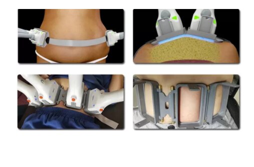 professional effective laser treatment cellulite removal skin tightening weight loss body contouring machine laser diode 1060 - Image 4