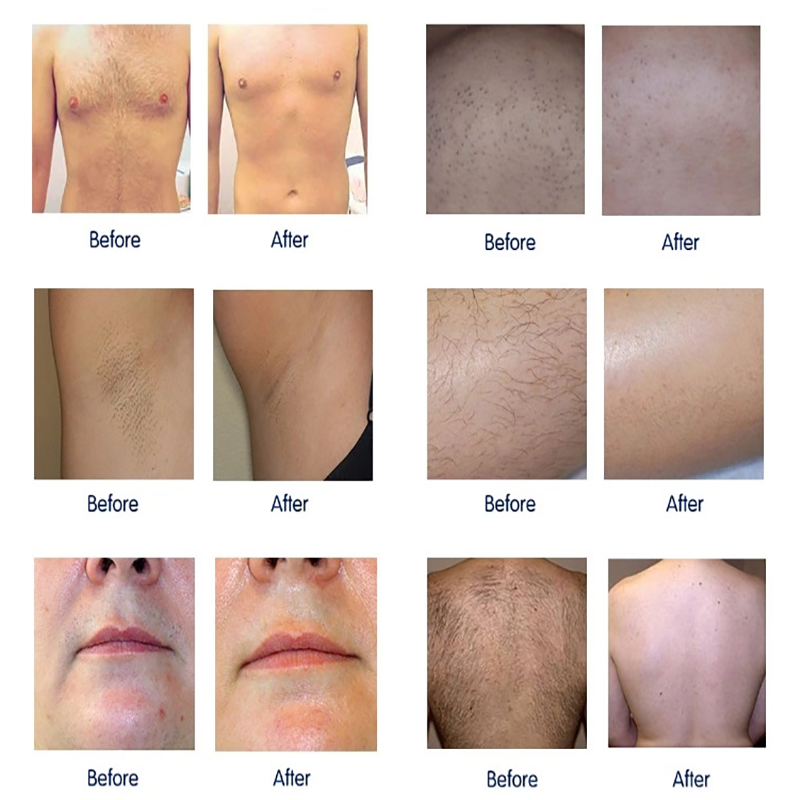 Diode Laser 755 808 1064nm Multi Wavelengths Hair Removal Machine Cooling Head Painless Laser Epilator Face Body Hair Removal - Image 3